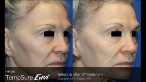 TempSure-Envi-Before-and-After-Image-768x432-300x169